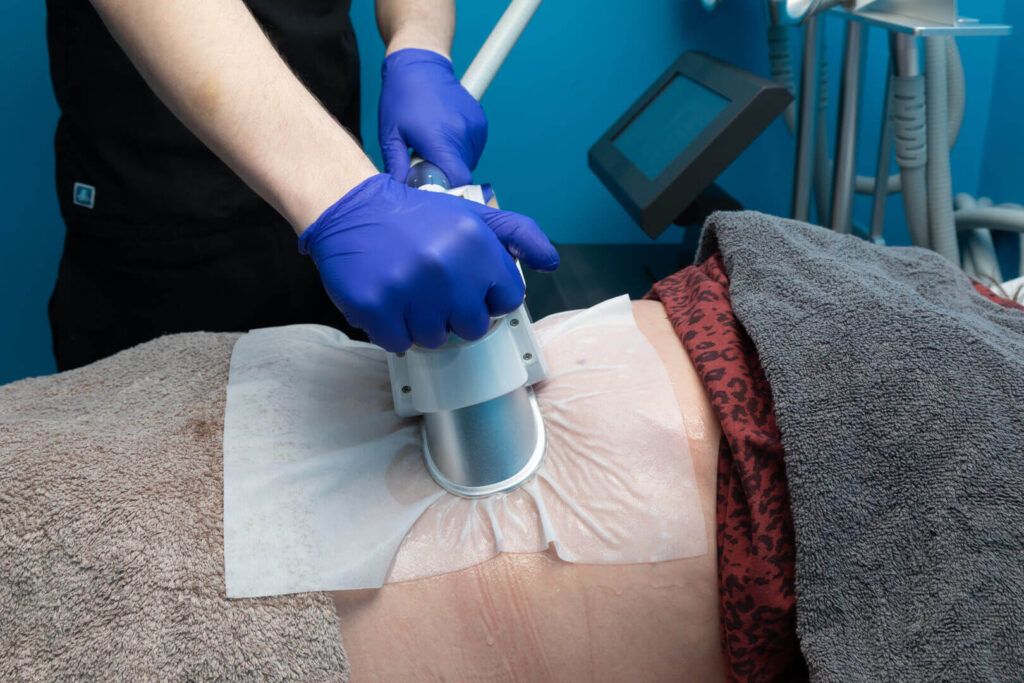Does CoolSculpting Require Downtime?