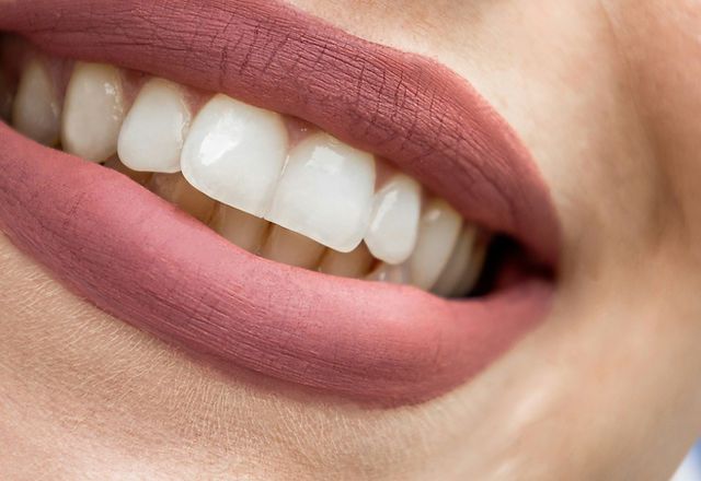 How Often Should You Use Teeth Whitening for the Best Effect