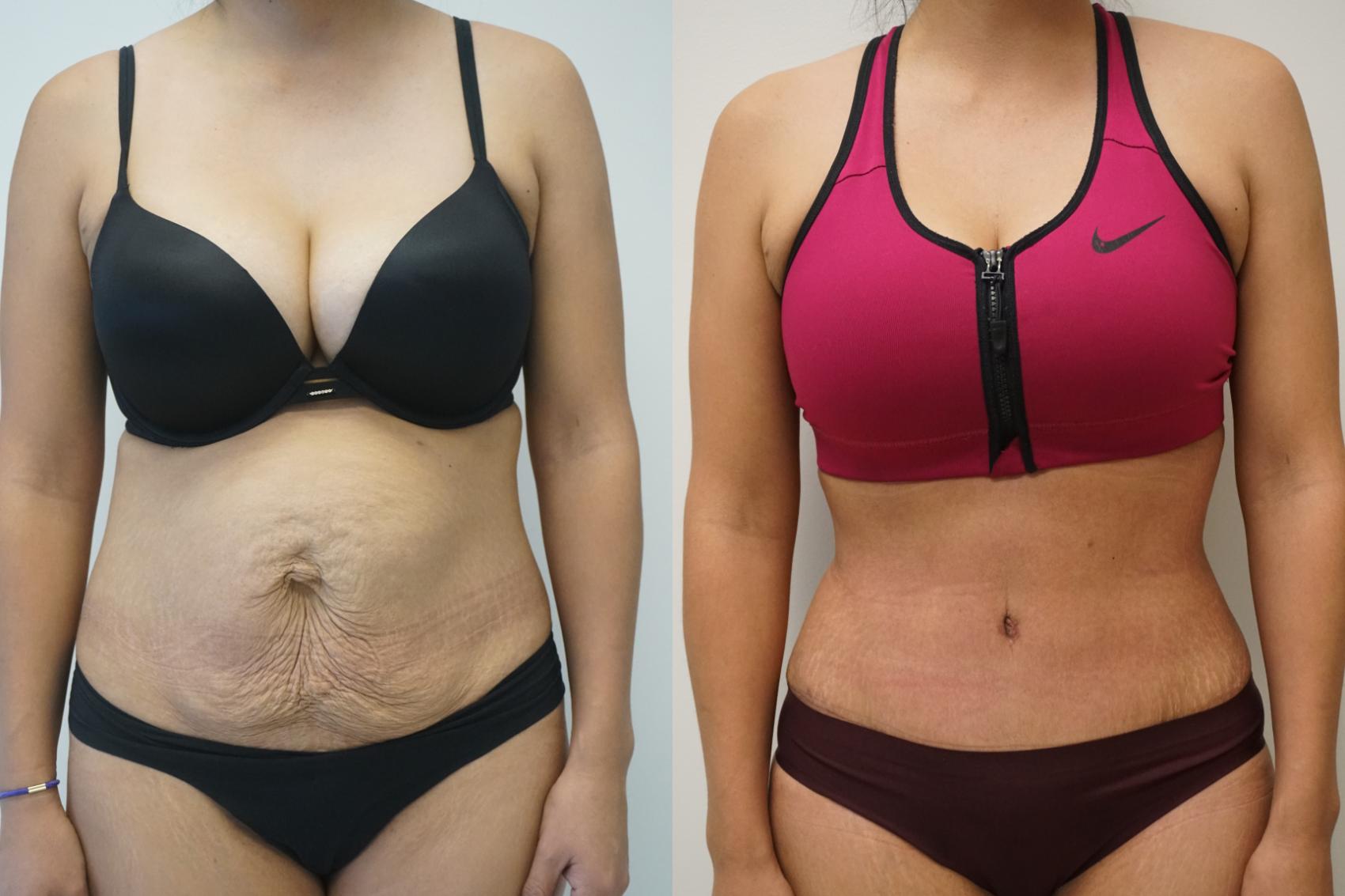 Tummy Tuck Plus Healthy Living Equals Body Goals