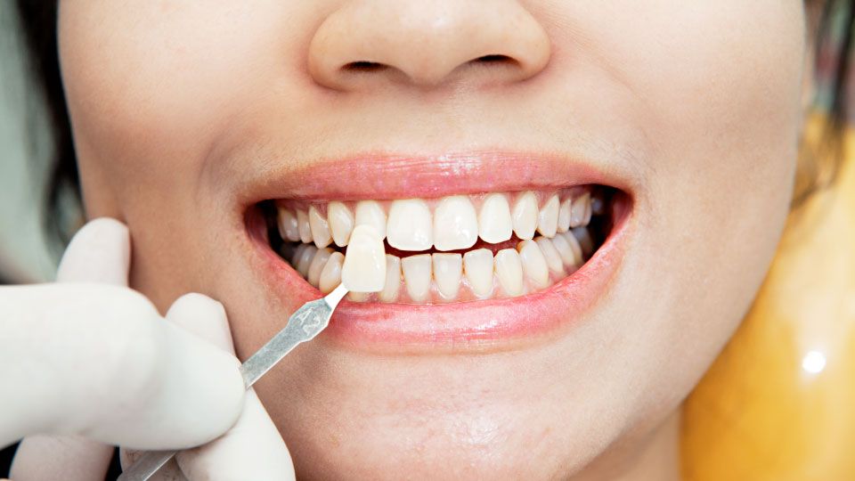 Can Dental Veneers Be Done Without Drilling?