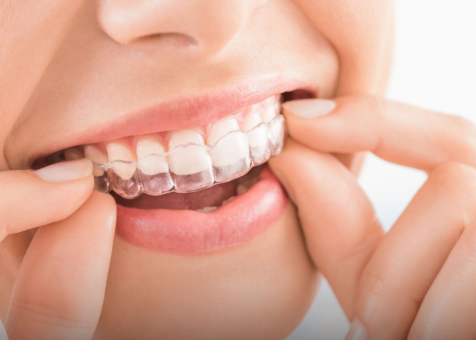 Can Invisalign Braces Treatment Worsen Tooth Sensitivity?