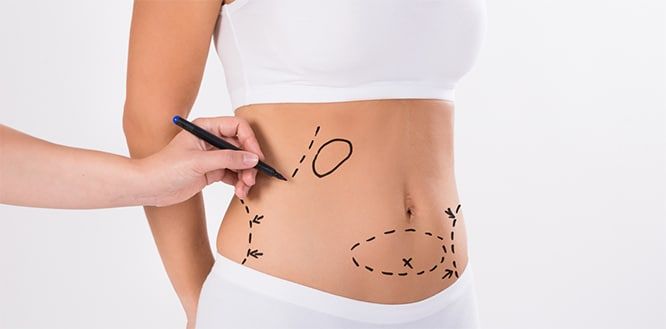 What Does a Tummy Tuck Belly Button Look Like?