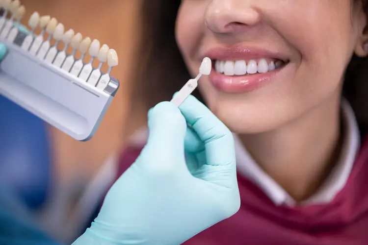 Do Dental Veneers Look Natural on Front Teeth?