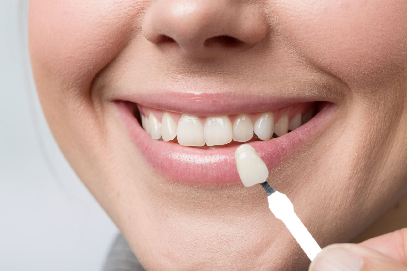 What Happens If a Dental Veneer Falls Off?