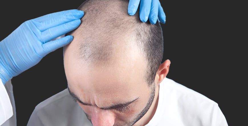 Hair Transplant Recovery Tips to Boost Hair Growth Fast
