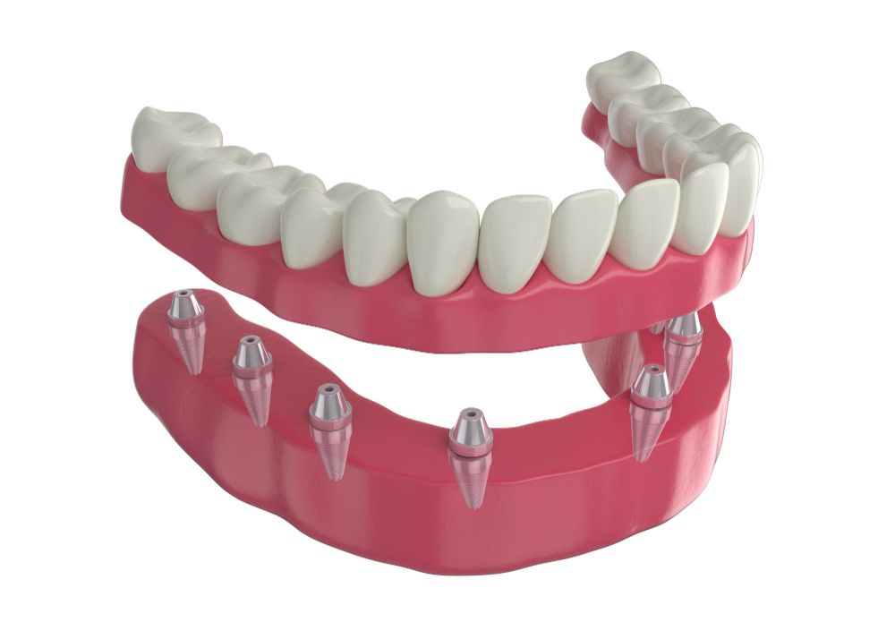 Can Diabetics Get Dental Implants? Things to Consider