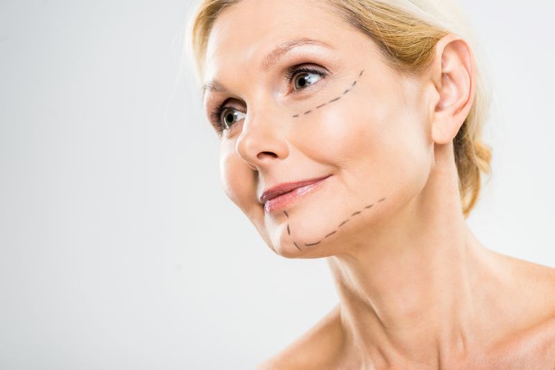Long-Term Results of Facelift Surgery Explained