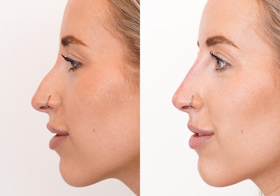 Can a Non-Surgical Nose Job Correct Nose Asymmetry?