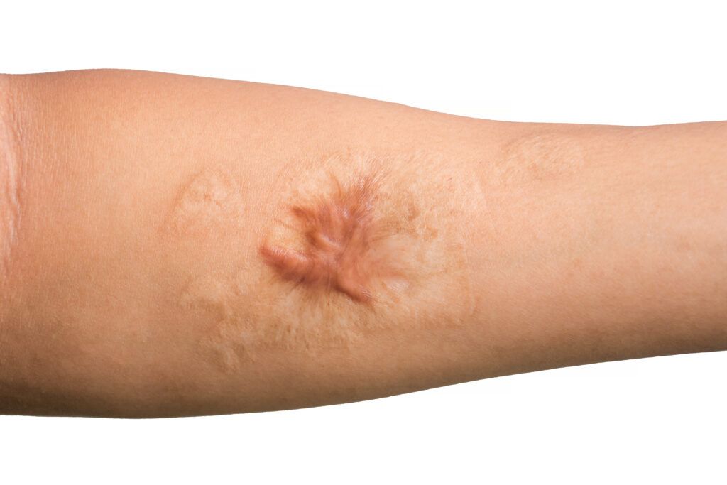 Surgical Scar Revision for Scar Minimization: How Effective Is It?