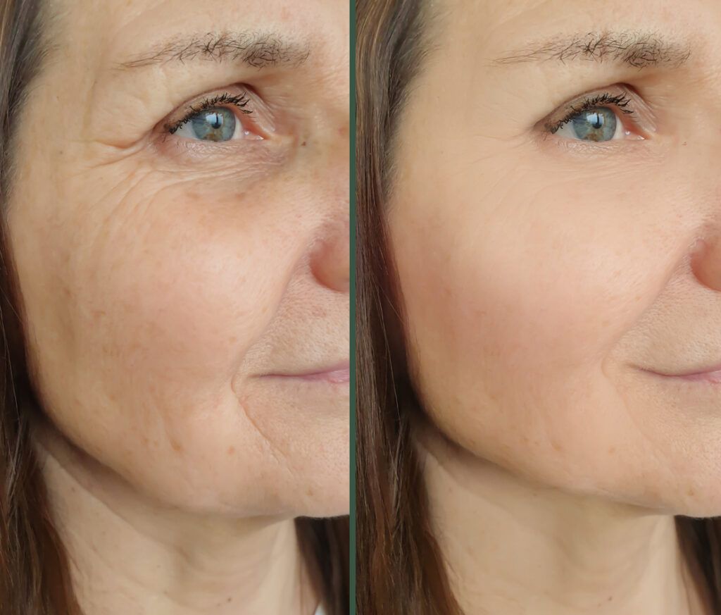 7 Reasons to Choose Enfield Royal Clinic for Sculptra Fillers
